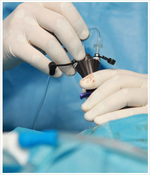 hernia repair